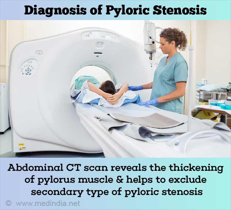 Pyloric Stenosis In Adults Print