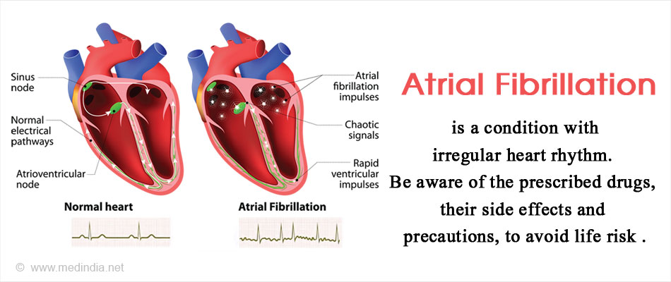 Atrial Fibrillationflutter Causes Symptoms Treatment Atrial Images