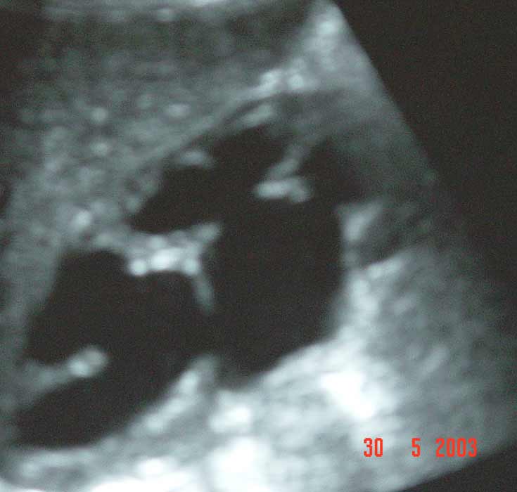 Unilateral Hydronephrosis