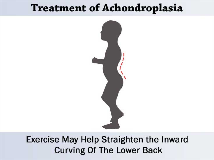 Exercises May Help Straighten the Inward Curving Of The Lower Back