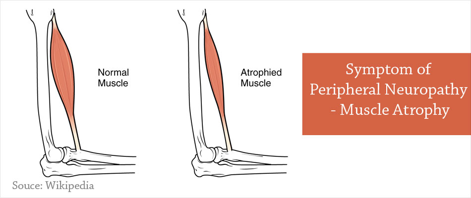 Peripheral Neuropathy - Types, Causes, Symptoms, Diagnosis, Treatment ...