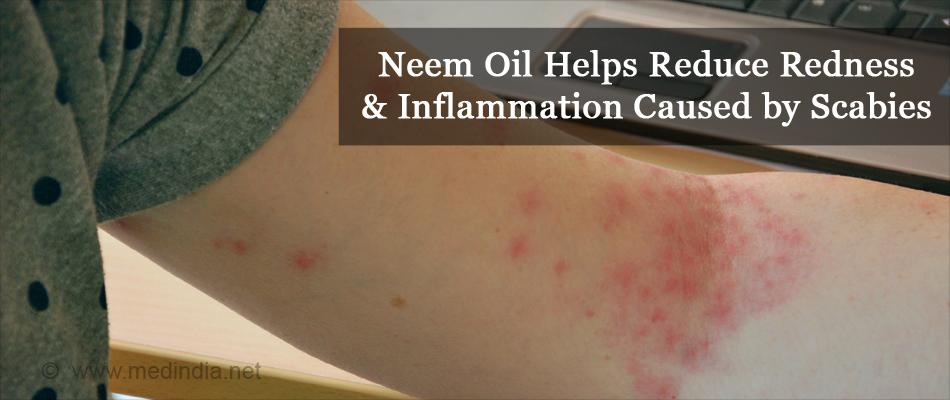 Here's How Neem Oil Can Keep Your Skin Healthy