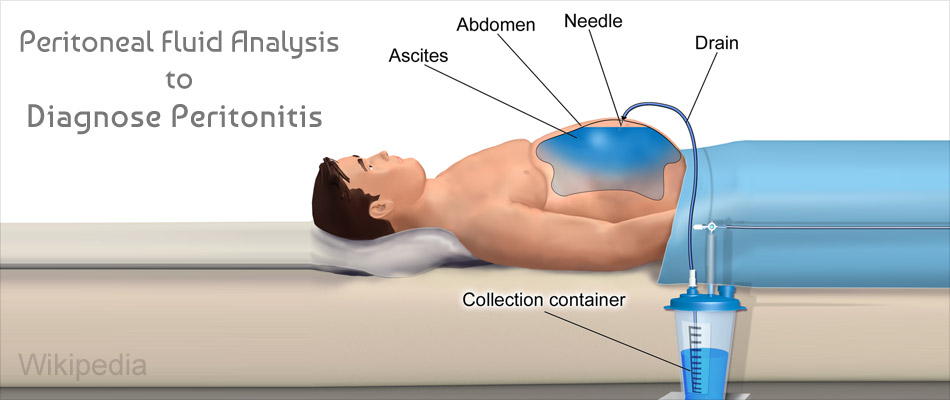 Peritonitis Causes Symptoms Diagnosis Management Nurs - vrogue.co