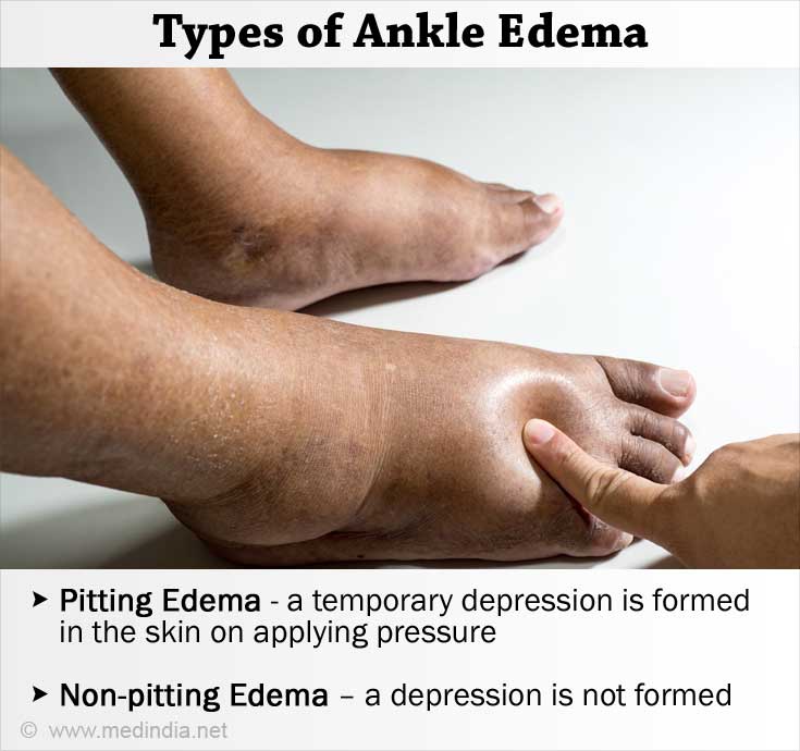 Pitting and Nonpitting Edema