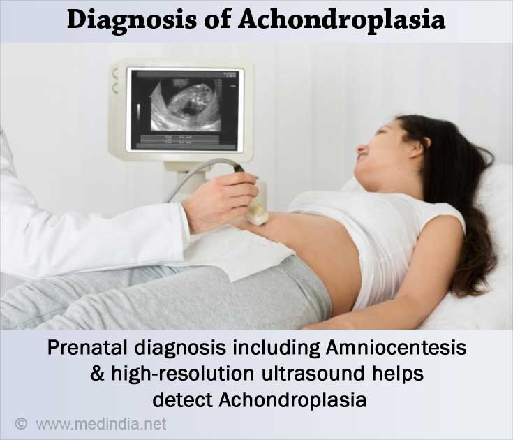 Achondroplasia - Causes, Symptoms, Diagnosis, Treatment