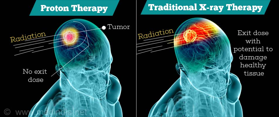 Proton Beam Therapy for Cancer Treatment