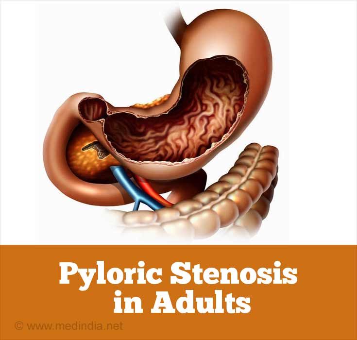 Pyloric Stenosis In Adults Print