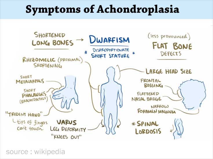 Achondroplasia Causes Symptoms Diagnosis Treatment