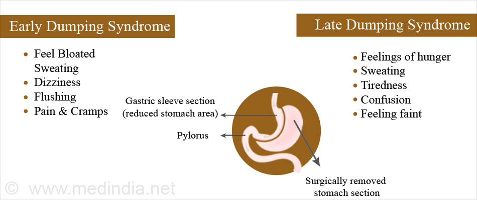 Dumping Syndrome Causes Symptoms Diagnosis Treatment