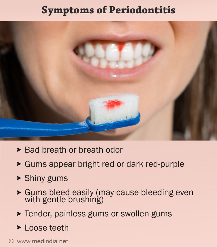 Symptoms of Periodontitis