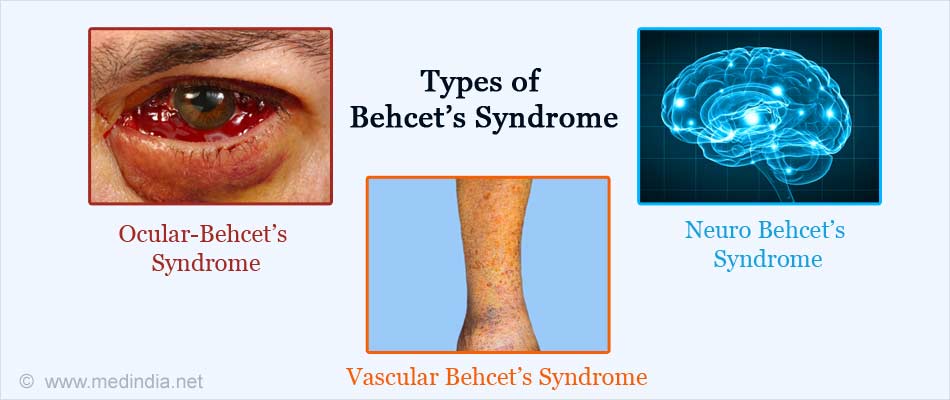 Behcet S Syndrome Behcet S Disease Causes Symptoms Diagnosis Treatment And Prognosis