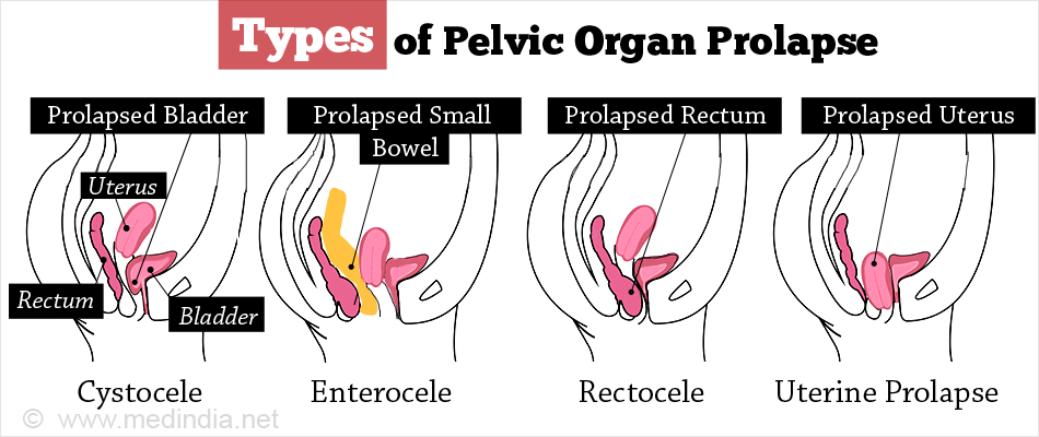 Pelvic Organ Prolapse Types Causes Symptoms Diagnosis Treatment 4551
