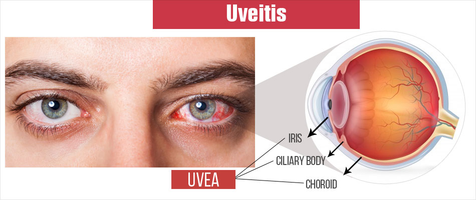 Uveitis Eye Inflammation Causes, Symptoms