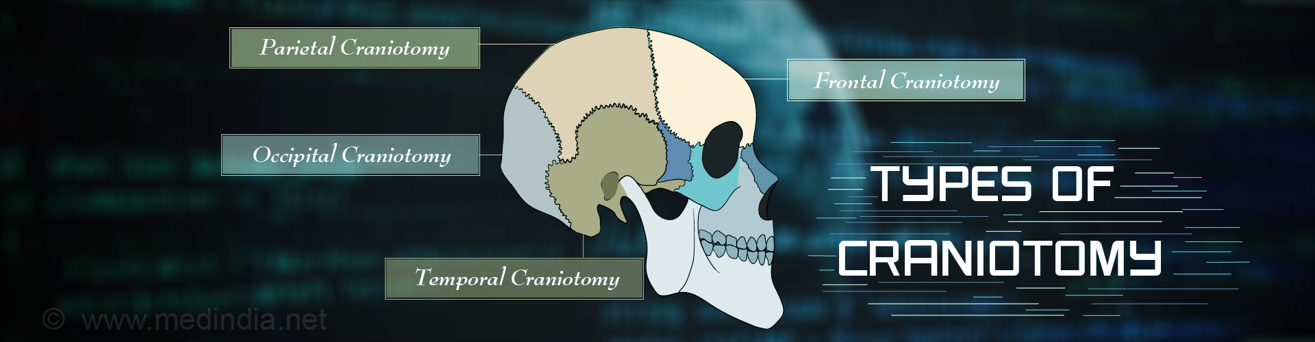 Craniotomy - Types, Indications, Procedure, Complications