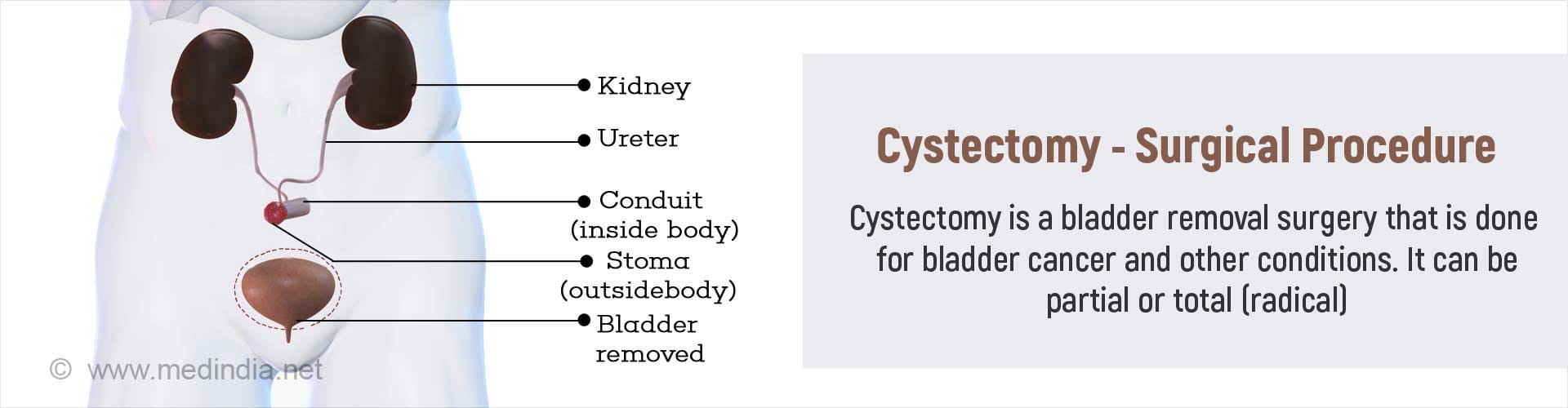 Cystectomy - Indications, Types, Procedures, Risks And Complications