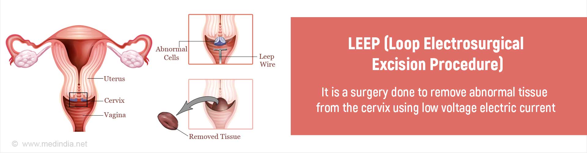 leep-loop-electrosurgical-excision-procedure-indications