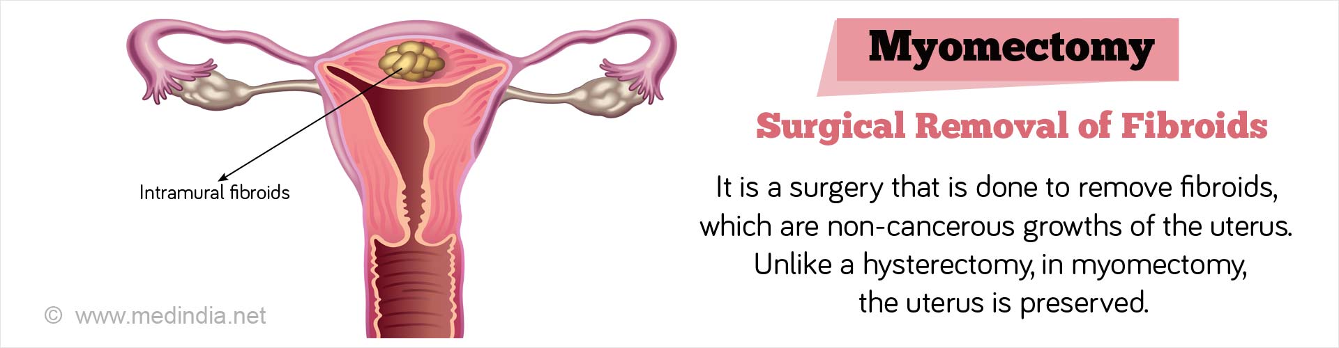 myomectomy procedure types indications complications medindia surgical preparation procedures surgicalprocedures