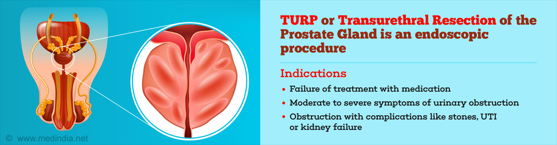 Transurethral Resection Of Prostate Turp For Prostate Enlargement 8033