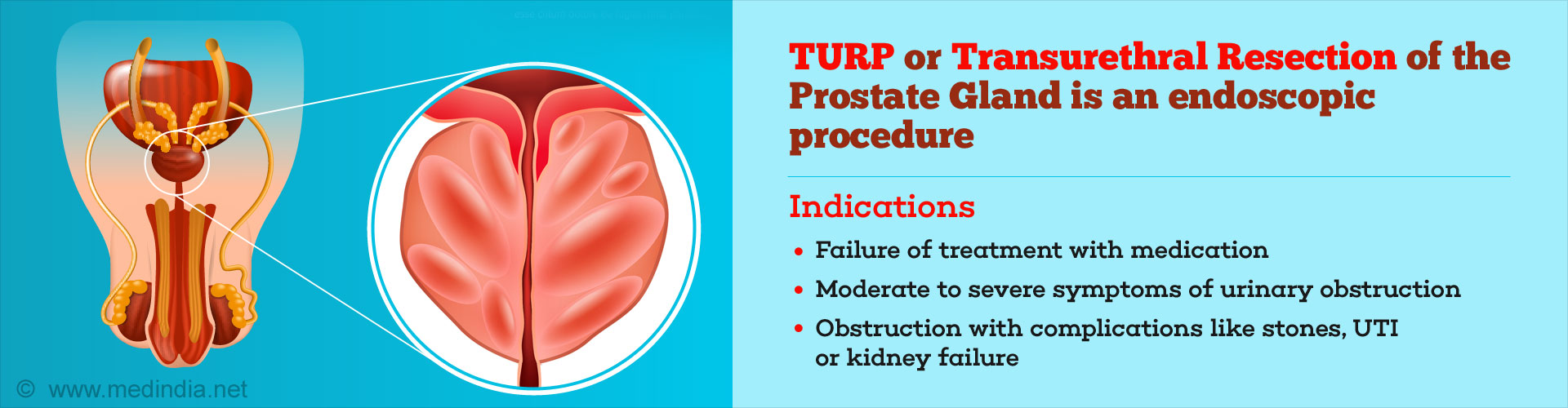 Transurethral Resection Of Prostate TURP For Prostate Enlargement