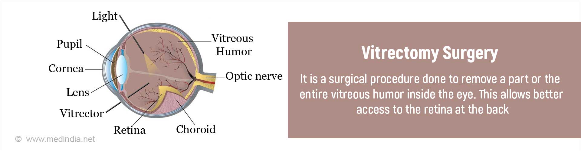 vitrectomy-surgery-types-indications-procedure-complications