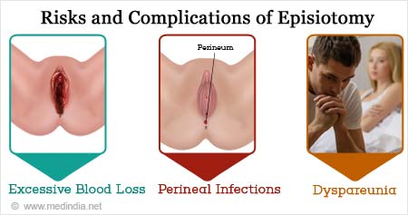 Episiotomy Types Risks Complications