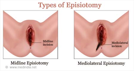 Episiotomy Types Risks Complications