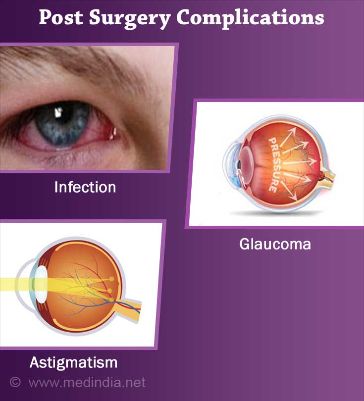 Corneal Transplantation