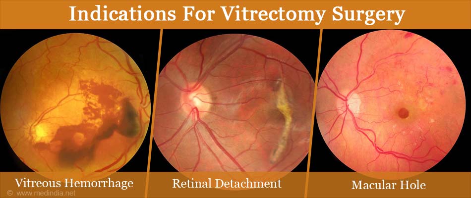 Vitrectomy Surgery - Types, Indications, Procedure & Complications