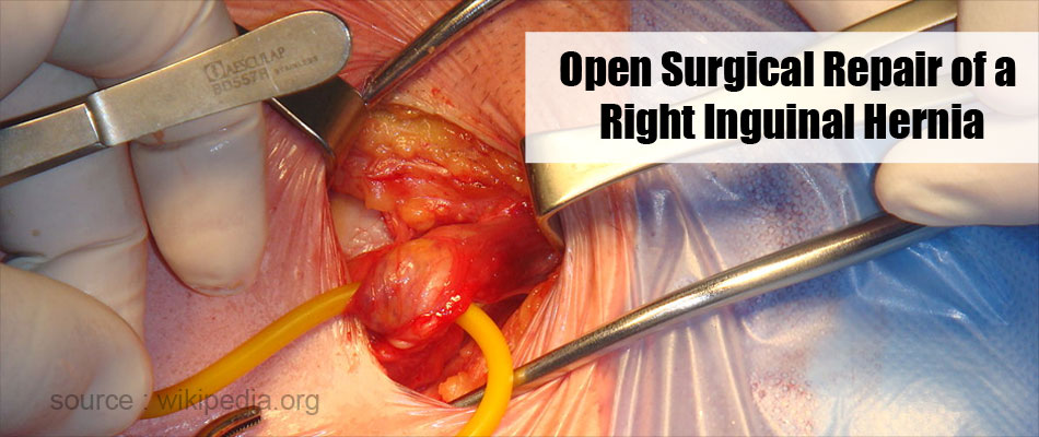  Inguinal  Hernia Surgery Inguinal  Hernia Repair