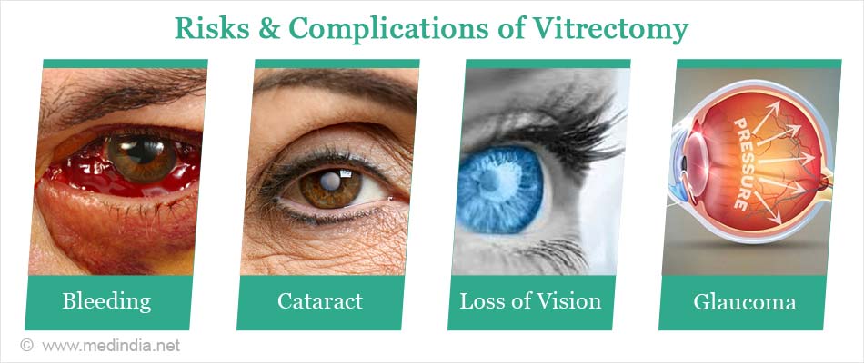 Vitrectomy Surgery - Types, Indications, Procedure & Complications