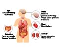 Amyloidosis