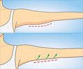 Arm Liposuction