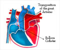 Balloon Atrial Septostomy