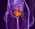 Bladder Cancer - Infographics