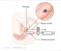 Brachytherapy for Prostate Cancer