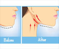 What You Ought to Know About Chin Reconstruction