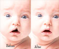 Cleft Palate Surgery / Palatoplasty