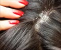 Foods to Get Rid of Dandruff - Slide Show