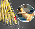 Ganglionectomy