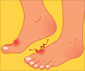 Home Remedies for Gout