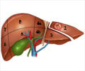 Hepatectomy