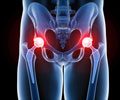 Hip Replacement Surgery