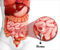 Ileostomy - Surgical procedure