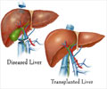 Liver Transplantation Part 1: Procedure & Techniques