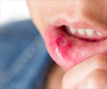 Home Remedies for Mouth Ulcer