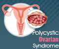 Polycystic Ovarian Syndrome - Infographics
