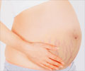 How to Get Rid of Pregnancy Stretch Marks Naturally