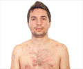 Test Your Knowledge on Chickenpox