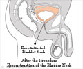 Radical Prostatectomy