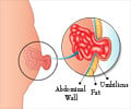 Umbilical Hernia - Surgical Procedure